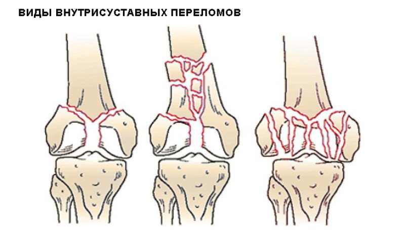 Контузионные изменения кости. Переломы мыщелков бедренной кости. Перелом мыщелка локтевого сустава. Эпифизарный внутрисуставной перелом схема. Перелом большеберцовой кости в коленном суставе.