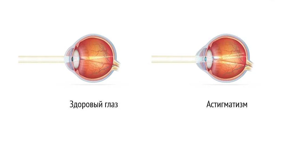 Плохое зрение передавалось. Миопия передается по наследству. Может ли плохое зрение передаваться по наследству.